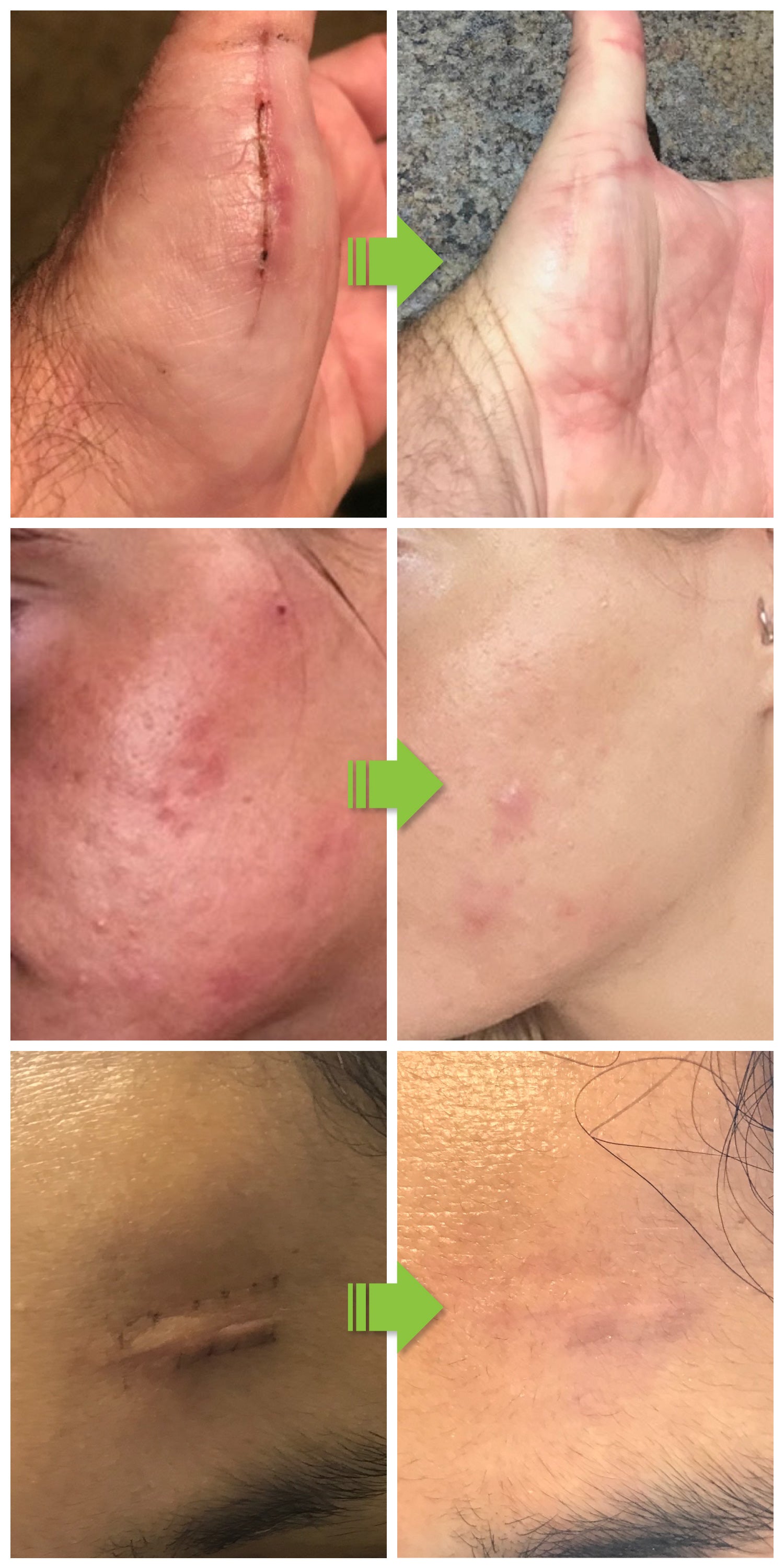 Before and After Images from using Derminish Scar Wipes