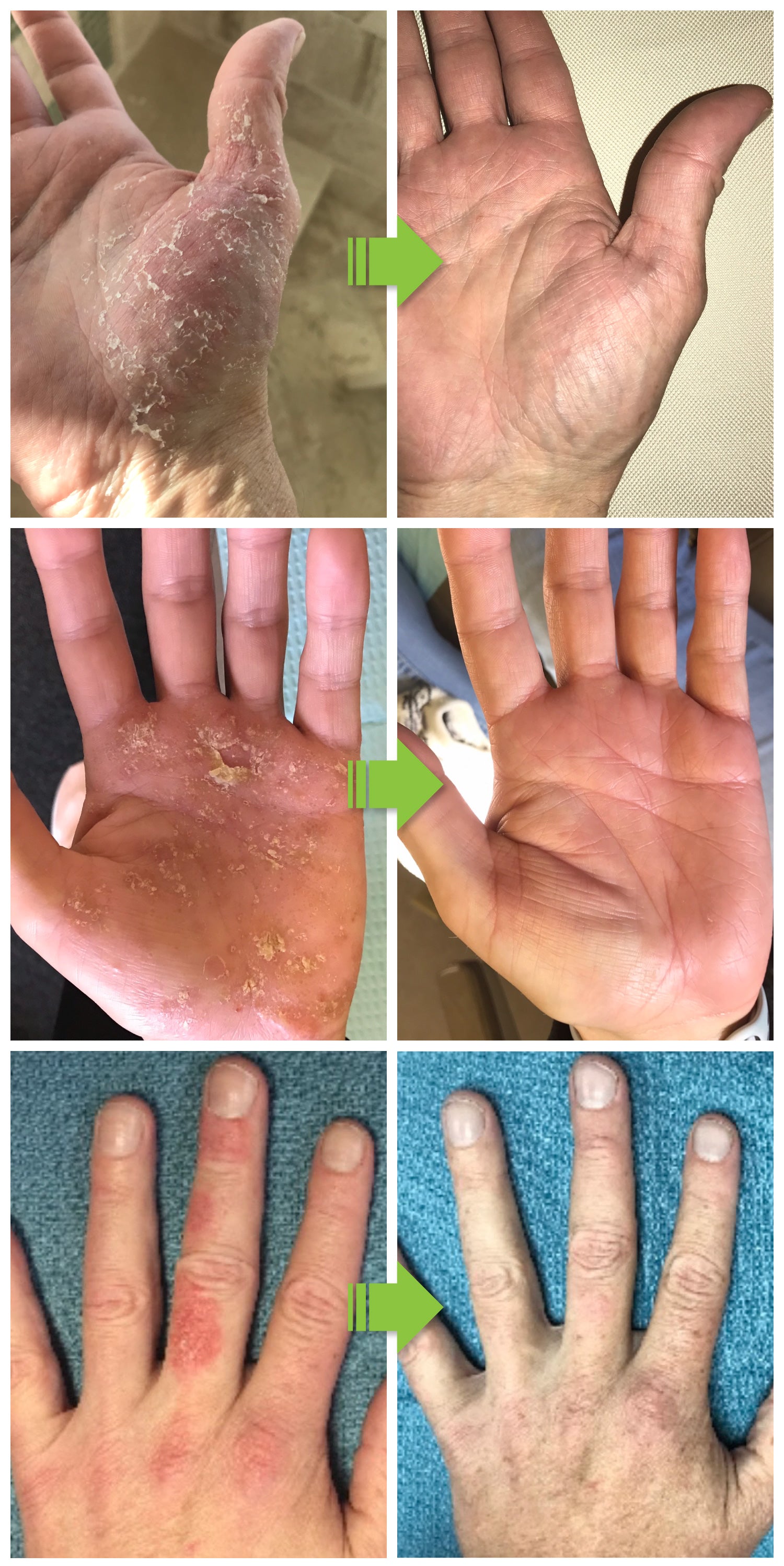 Amazing results from using Eczema Flare Wipes.