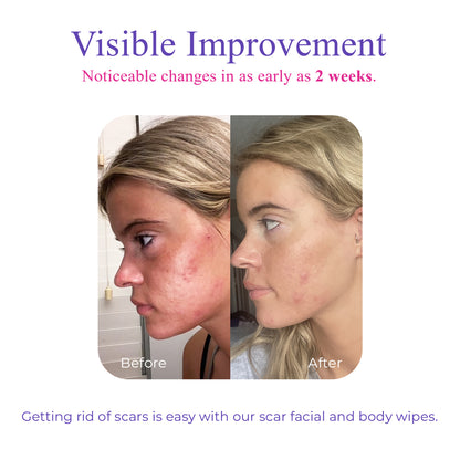 Visible improvement: Noticeable changes in as early as 2 weeks. getting rid of scars is easy with our scar facial and body wipes.